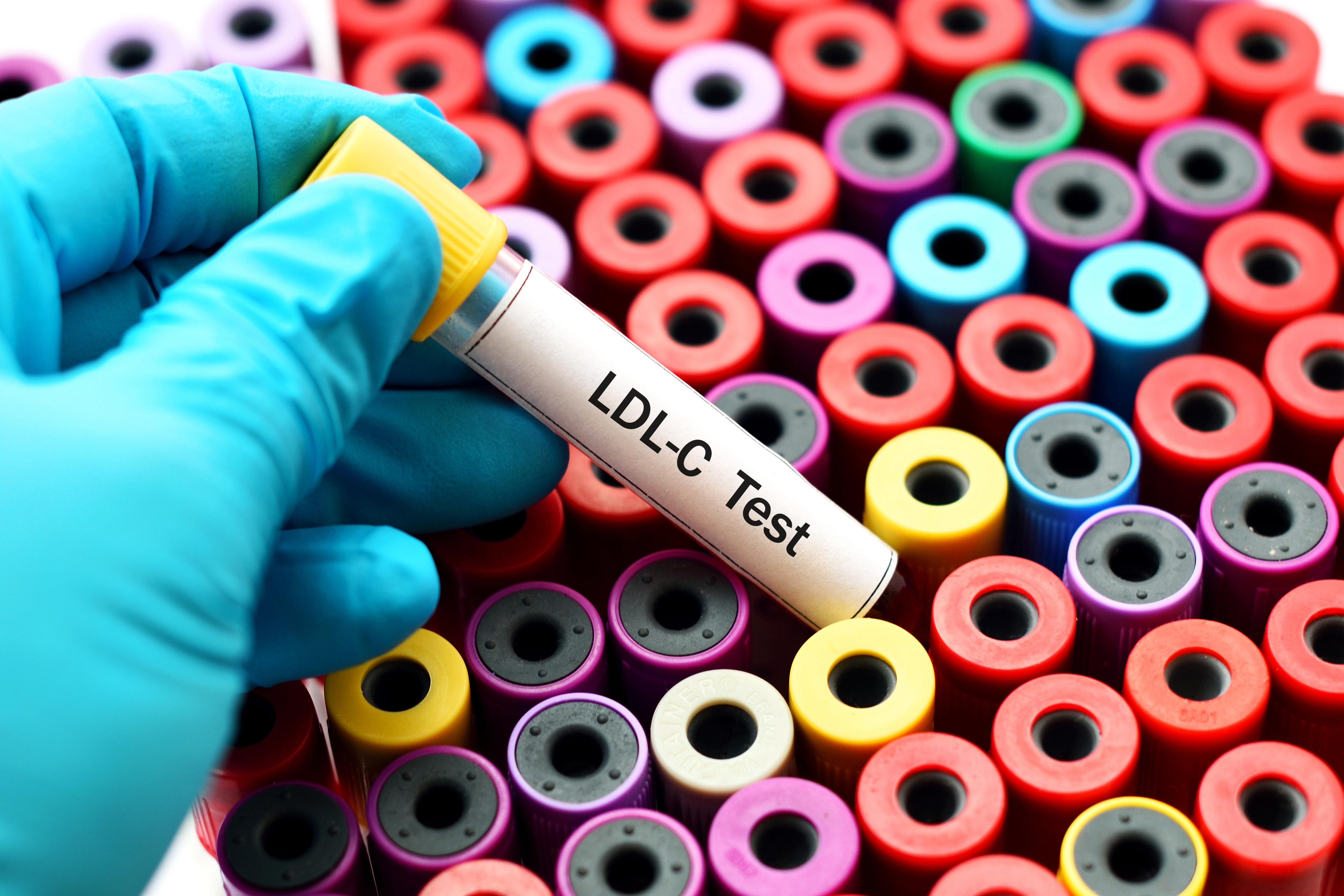 High cholesterol and lipid disorders