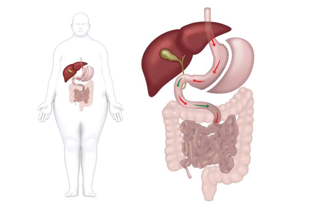 bypass gastrico