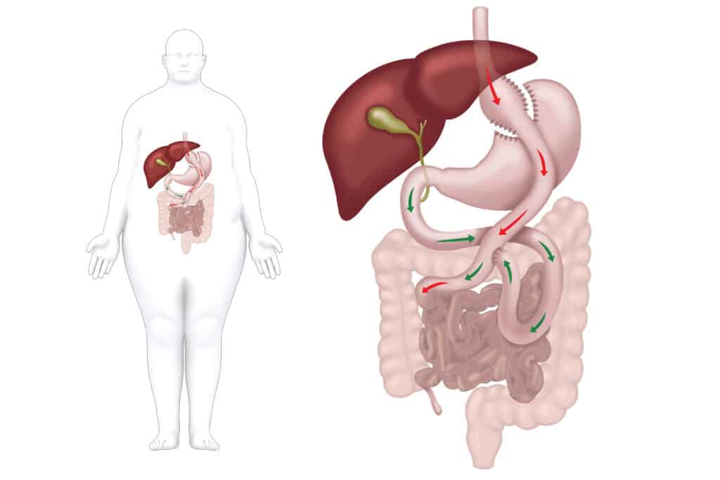 DIVERSIONE BILIOPANCREATICA (BPD) E DUODENAL SWITCH (DS)