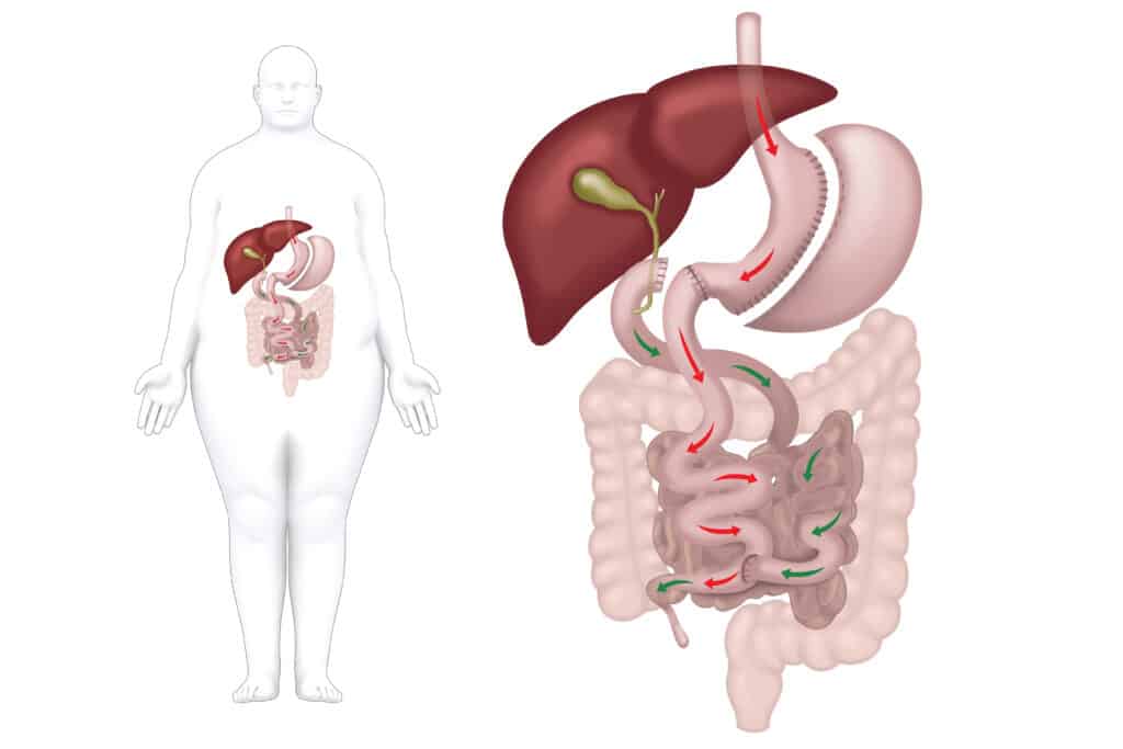 sleeve gastrectomy